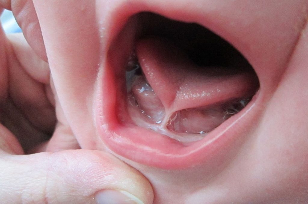 اسباب التصاق اللسان عند الاطفال وطرق علاجه